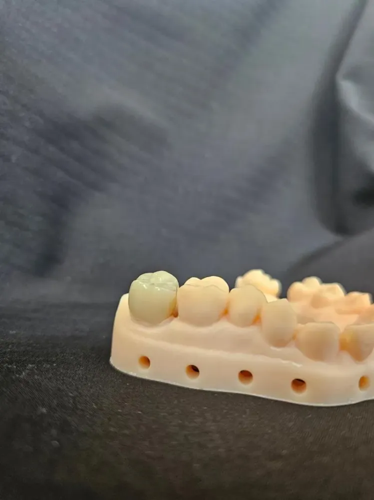 Spécialistes-des-implants-dentaires-à-Monistrol-sur-Loire
